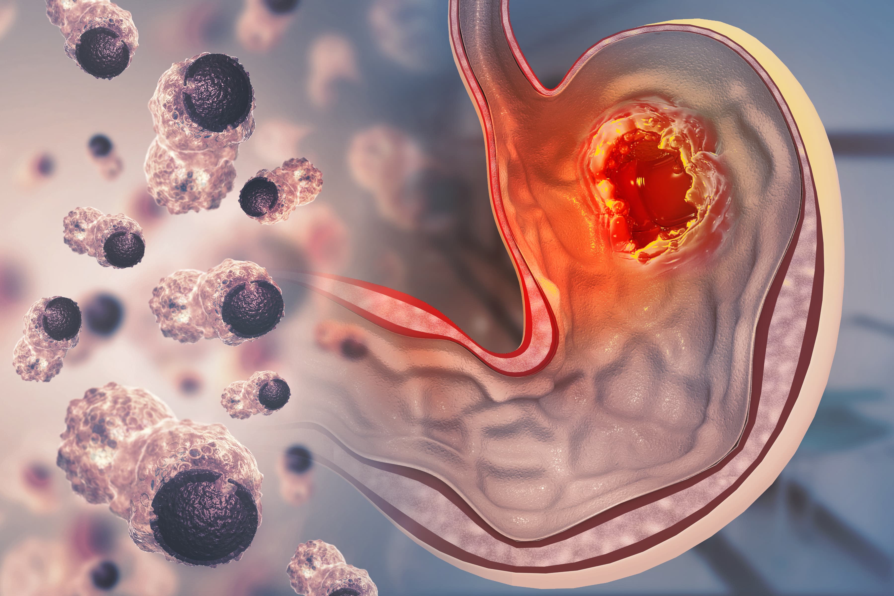 Pembrolizumabe recebe aprovação definitiva do FDA para câncer gástrico HER-2 positivo com expressão de PD-L1