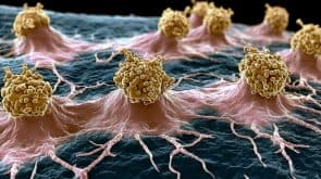 Regime combinado perioperatório é aprovado pelo FDA para tratamento do câncer de bexiga músculo-invasivo