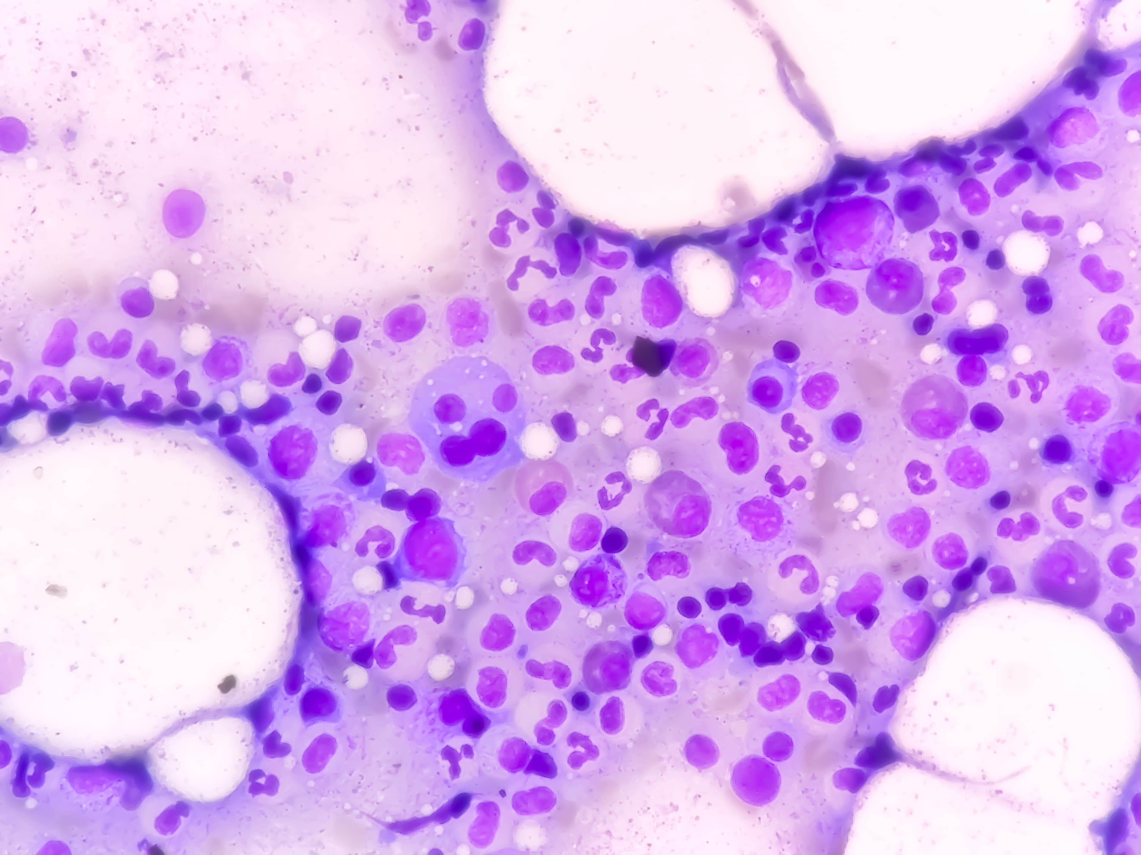 Daratumumabe recebe aprovação de nova indicação terapêutica em formulação subcutânea pelo FDA