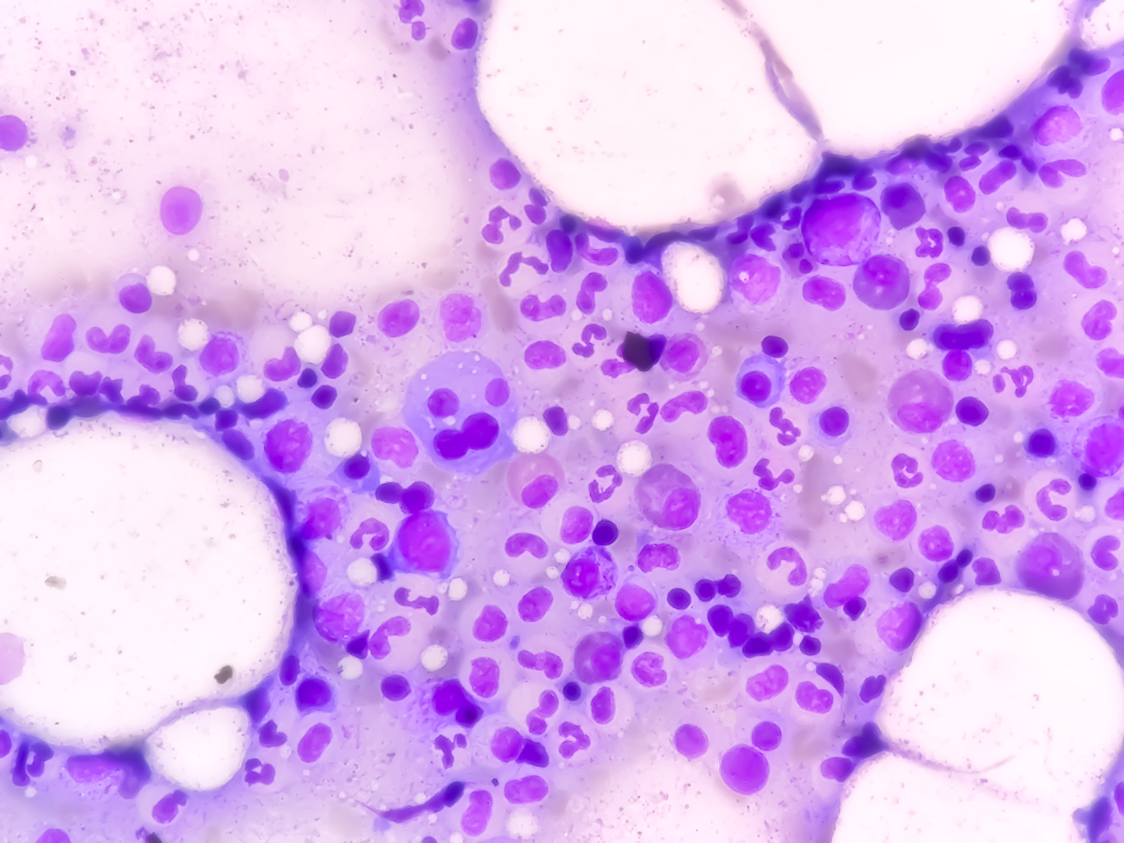 Daratumumab recibe la aprobación de una nueva indicación terapéutica en formulación subcutánea por el FDA